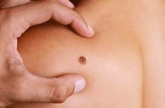 Salud llama a detectar a tiempo el sarcoma, cáncer poco frecuente que puede afectar a cualquier edad