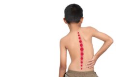 ¿Cómo puede un padre detectar una escoliosis a tiempo?