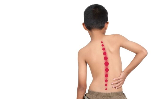¿Cómo puede un padre detectar una escoliosis a tiempo?