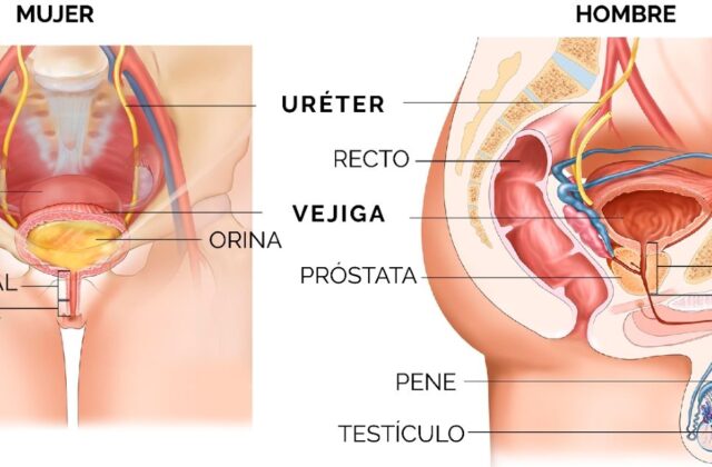 ¿Cómo afecta la calidad de vida en el paciente con estrechez uretral?