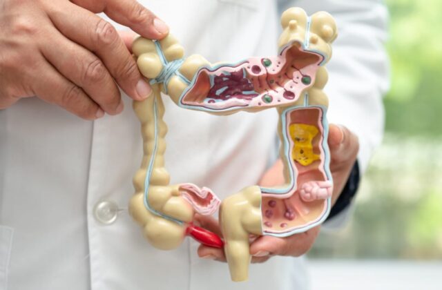 Crohn y colitis ulcerosa son enfermedades crónicas que inflaman el intestino