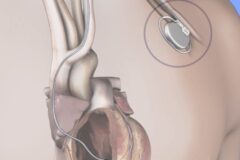 Cardiólogos respaldan uso de desfibrilador implantable para prevenir la muerte súbita