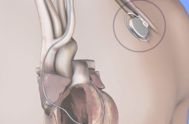 Cardiólogos respaldan uso de desfibrilador implantable para prevenir la muerte súbita