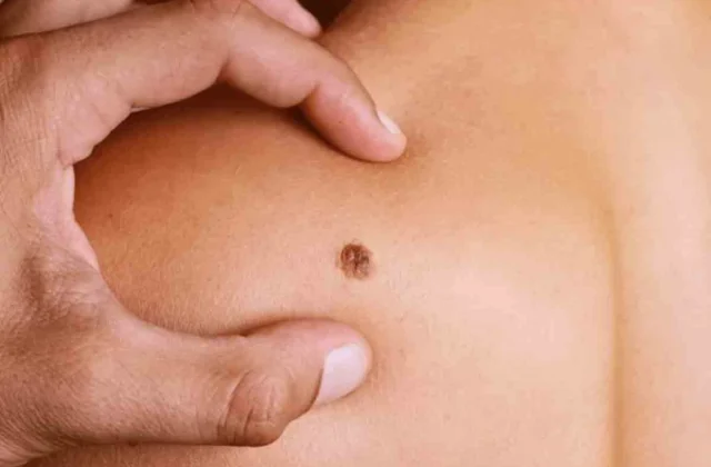 Salud llama a detectar a tiempo el sarcoma, cáncer poco frecuente que puede afectar a cualquier edad