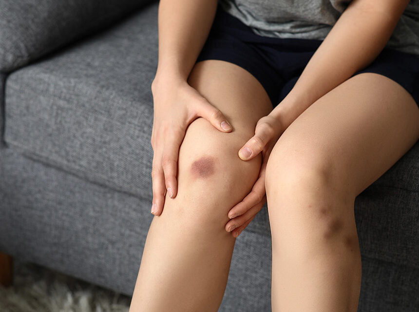 ¿Te salen moretones sin golpearte? Estas son las señales de alerta