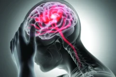 Dominicana registra al menos 60 casos diarios de accidentes cerebrovasculares